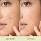 Renee Acne Filter|15 gms|MRP 399