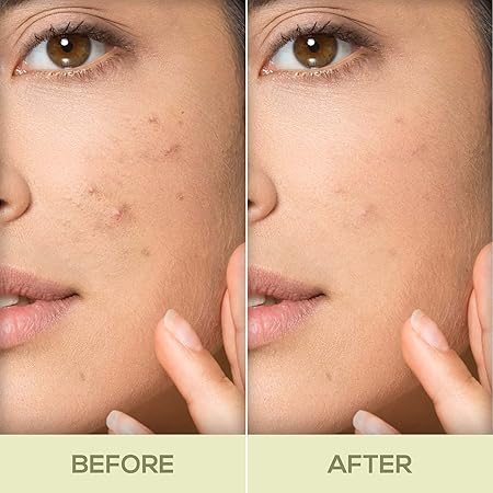 Renee Acne Filter|15 gms|MRP 399